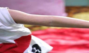 أطباء بلا حدود تعلن ارتفاع عدد حالات الإصابة بالحصبة في شبوة