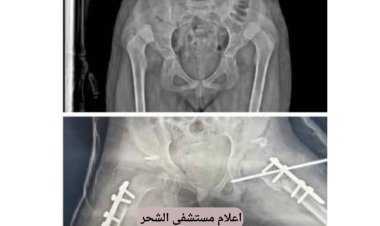 رغم شحة الإمكانيات نجاح عميلة نوعية بمستشفى الشحر العام