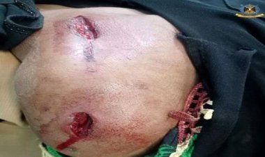 إصابة إمرأة برصاصة قناص حوثي بالضالع