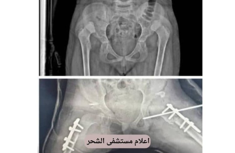 رغم شحة الإمكانيات نجاح عميلة نوعية بمستشفى الشحر العام