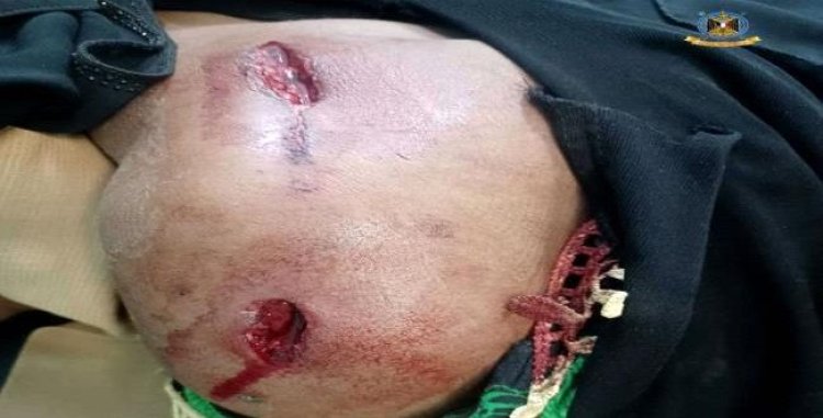 إصابة إمرأة برصاصة قناص حوثي بالضالع